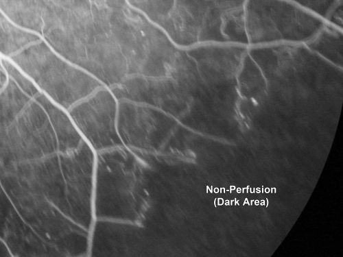 Proliferative Diabetic Retinopathy Both Eyes - Vitreous Hemorrahge Left Eye - Dark Area is Non-Perfusion
67-year-old man has proliferative diabetic retinopathy in both eyes with vitreous hemorrhage in the left eye.  He has had pan retinal laser in the left eye.  The vitreous hemorrhage has been there for greater than two years and his vision is still hazy.  He takes Lumigan in both eyes for his glaucoma.  

VISUAL ACUITY:  OD 20/40,  OS 20/40

