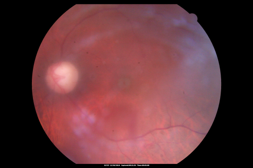 Proliferative Diabetic Retinopathy Both Eyes - Vitreous Hemorrahge Left Eye
67-year-old man has proliferative diabetic retinopathy in both eyes with vitreous hemorrhage in the left eye.  He has had pan retinal laser in the left eye.  The vitreous hemorrhage has been there for greater than two years and his vision is still hazy.  He takes Lumigan in both eyes for his glaucoma.  

VISUAL ACUITY:  OD 20/40,  OS 20/40
