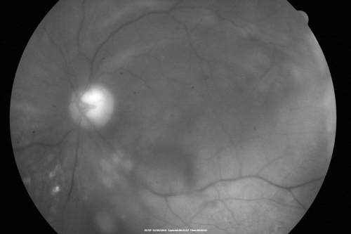 Proliferative Diabetic Retinopathy Both Eyes - Vitreous Hemorrahge Left Eye
67-year-old man has proliferative diabetic retinopathy in both eyes with vitreous hemorrhage in the left eye.  He has had pan retinal laser in the left eye.  The vitreous hemorrhage has been there for greater than two years and his vision is still hazy.  He takes Lumigan in both eyes for his glaucoma.  

VISUAL ACUITY:  OD 20/40,  OS 20/40

