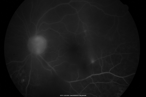 Proliferative Diabetic Retinopathy Both Eyes - Vitreous Hemorrahge Left Eye
67-year-old man has proliferative diabetic retinopathy in both eyes with vitreous hemorrhage in the left eye.  He has had pan retinal laser in the left eye.  The vitreous hemorrhage has been there for greater than two years and his vision is still hazy.  He takes Lumigan in both eyes for his glaucoma.  

VISUAL ACUITY:  OD 20/40,  OS 20/40
