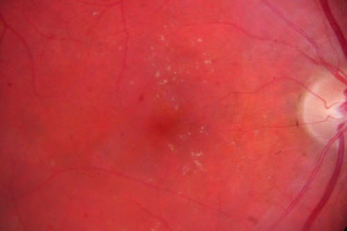 BDR OD with Macular Edema
