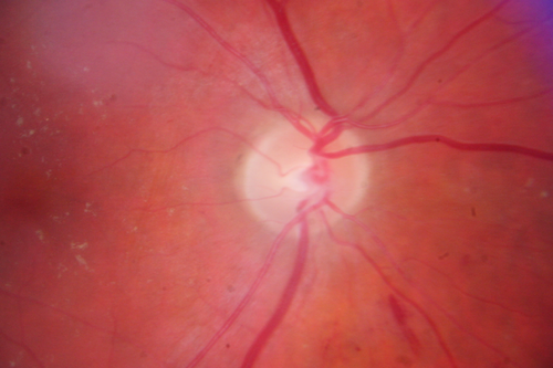 BDR OD with Macular Edema

