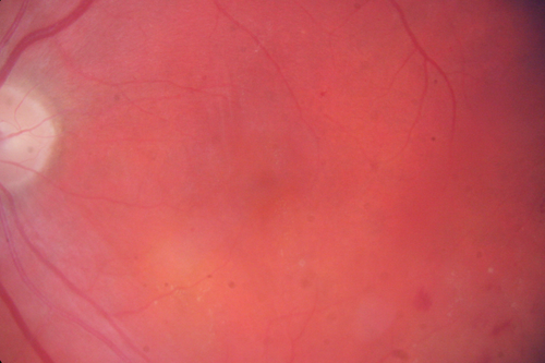 Neovascularization elsewhere (NVE) Left Eye with Vitreous Hemorrhage
