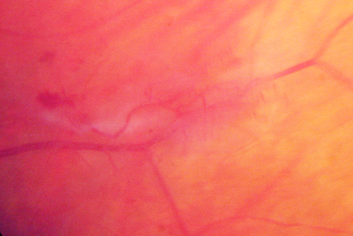 Neovascularization elsewhere (NVE) Left Eye with Vitreous Hemorrhage
