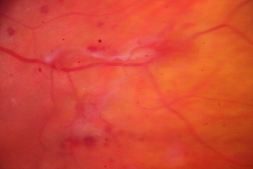 Neovascularization elsewhere (NVE) Left Eye with Vitreous Hemorrhage
