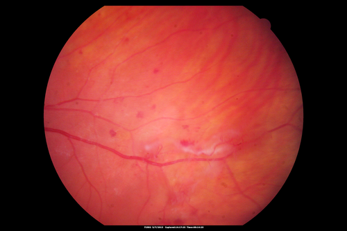 Neovascularization elsewhere (NVE) Left Eye with Vitreous Hemorrhage
