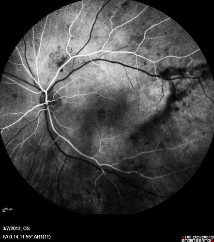Proliferative Diabetic Retinopathy and Vitreous Hemorrhage - FA shows leakage of dye from NVE
