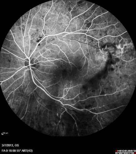 Proliferative Diabetic Retinopathy and Vitreous Hemorrhage - FA shows leakage of dye from NVE
