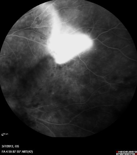Proliferative Diabetic Retinopathy and Vitreous Hemorrhage - FA shows leakage of dye from NVE
