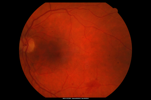 Proliferative Diabetic Retinopathy both Eyes Neovascularization of the Disc
63-year-old woman has been diabetic for twenty one years who sees new floaters in the right eye.  OD 20/40,  OS 20/40.
Mots-clés: PDR;proliferative diabetic retinopathy;nvd;nve