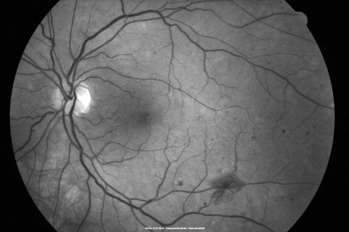 Proliferative Diabetic Retinopathy both Eyes Neovascularization of the Disc
63-year-old woman has been diabetic for twenty one years who sees new floaters in the right eye.  OD 20/40,  OS 20/40.
Keywords: PDR;proliferative diabetic retinopathy;nvd;nve