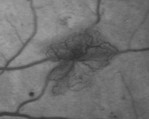 Proliferative Diabetic Retinopathy both Eyes Neovascularization of the Disc
63-year-old woman has been diabetic for twenty one years who sees new floaters in the right eye.  OD 20/40,  OS 20/40.
Keywords: PDR;proliferative diabetic retinopathy;nvd;nve