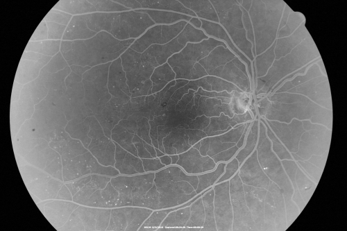Proliferative Diabetic Retinopathy both Eyes Neovascularization of the Disc
63-year-old woman has been diabetic for twenty one years who sees new floaters in the right eye.  OD 20/40,  OS 20/40.
Keywords: PDR;proliferative diabetic retinopathy;nvd;nve
