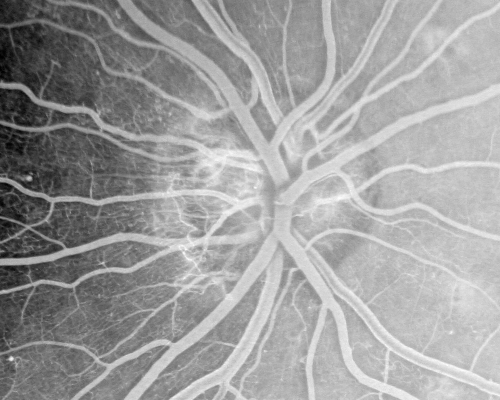 Proliferative Diabetic Retinopathy both eyes Type I Diabetic for 25 years
47-year-old woman with diabetes for 25 years and decreased vision for 3 months.  OD 20/40, OS 20/40
