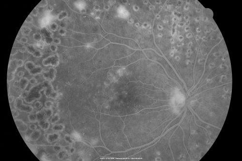 Proliferative Diabetic Retinopathy both eyes Type I Diabetic for 25 years
47-year-old woman with diabetes for 25 years and decreased vision for 3 months.  OD 20/40, OS 20/40

