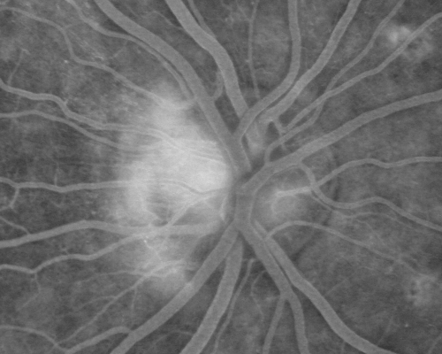 Proliferative Diabetic Retinopathy both eyes Type I Diabetic for 25 years
47-year-old woman with diabetes for 25 years and decreased vision for 3 months.  OD 20/40, OS 20/40
