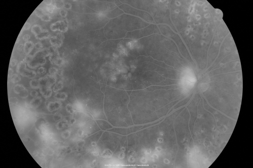 Proliferative Diabetic Retinopathy both eyes Type I Diabetic for 25 years
47-year-old woman with diabetes for 25 years and decreased vision for 3 months.  OD 20/40, OS 20/40
