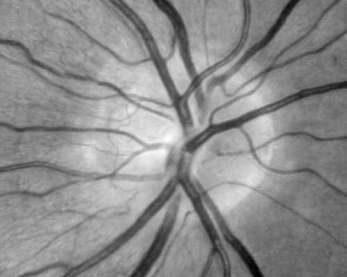 Proliferative Diabetic Retinopathy both eyes Type I Diabetic for 25 years
47-year-old woman with diabetes for 25 years and decreased vision for 3 months.  OD 20/40, OS 20/40
