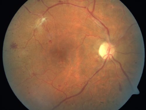 Proliferative Diabetic Retinopathy and Mild Vitreous Hemorrhage
58-year-old woman has diabetic retinopathy in both eyes with neovascularization of the optic nerve, worse in the right eye than the left eye.  Vision OD is 20/25, OS is 20/20

