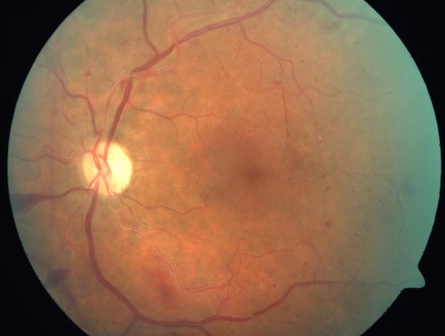 Proliferative Diabetic Retinopathy and Mild Vitreous Hemorrhage
58-year-old woman has diabetic retinopathy in both eyes with neovascularization of the optic nerve, worse in the right eye than the left eye.  Vision OD is 20/25, OS is 20/20
