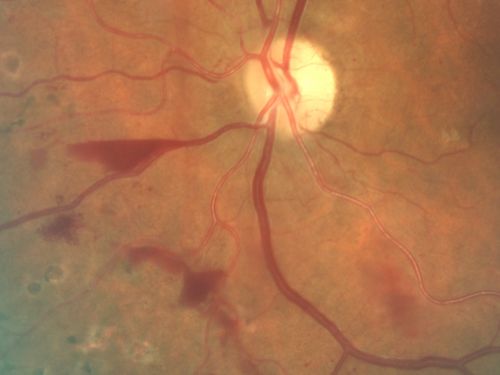 Proliferative Diabetic Retinopathy and Mild Vitreous Hemorrhage
58-year-old woman has diabetic retinopathy in both eyes with neovascularization of the optic nerve, worse in the right eye than the left eye.  Vision OD is 20/25, OS is 20/20
