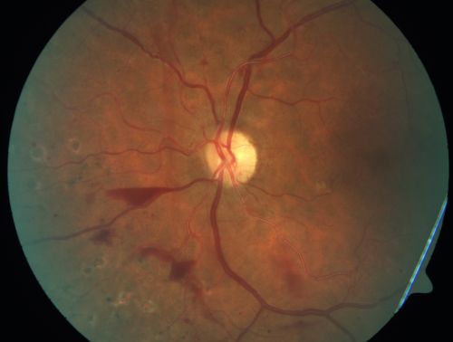 Proliferative Diabetic Retinopathy and Mild Vitreous Hemorrhage
58-year-old woman has diabetic retinopathy in both eyes with neovascularization of the optic nerve, worse in the right eye than the left eye.  Vision OD is 20/25, OS is 20/20
