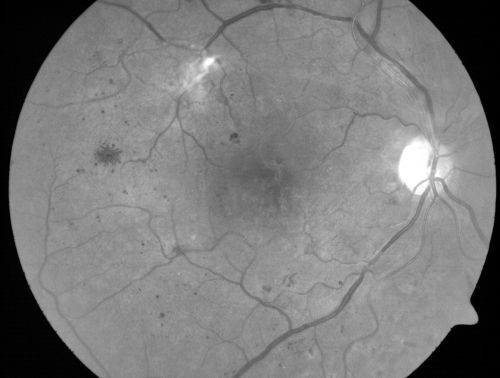 Proliferative Diabetic Retinopathy and Mild Vitreous Hemorrhage
58-year-old woman has diabetic retinopathy in both eyes with neovascularization of the optic nerve, worse in the right eye than the left eye.  Vision OD is 20/25, OS is 20/20
