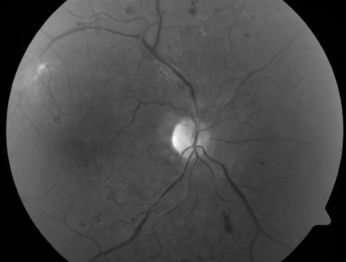 Proliferative Diabetic Retinopathy and Mild Vitreous Hemorrhage
58-year-old woman has diabetic retinopathy in both eyes with neovascularization of the optic nerve, worse in the right eye than the left eye.  Vision OD is 20/25, OS is 20/20
