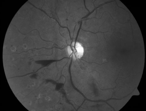 Proliferative Diabetic Retinopathy and Mild Vitreous Hemorrhage
58-year-old woman has diabetic retinopathy in both eyes with neovascularization of the optic nerve, worse in the right eye than the left eye.  Vision OD is 20/25, OS is 20/20

