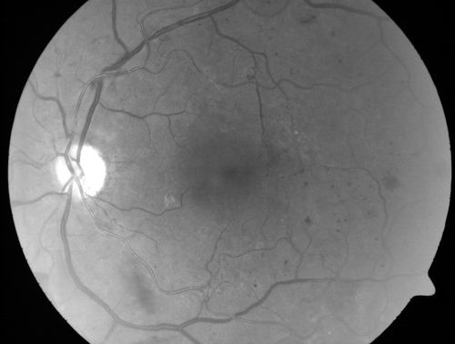 Proliferative Diabetic Retinopathy and Mild Vitreous Hemorrhage
58-year-old woman has diabetic retinopathy in both eyes with neovascularization of the optic nerve, worse in the right eye than the left eye.  Vision OD is 20/25, OS is 20/20
