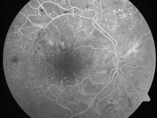 Proliferative Diabetic Retinopathy and Mild Vitreous Hemorrhage
58-year-old woman has diabetic retinopathy in both eyes with neovascularization of the optic nerve, worse in the right eye than the left eye.  Vision OD is 20/25, OS is 20/20
