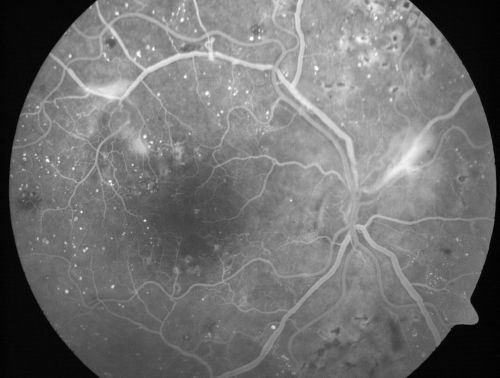 Proliferative Diabetic Retinopathy and Mild Vitreous Hemorrhage
58-year-old woman has diabetic retinopathy in both eyes with neovascularization of the optic nerve, worse in the right eye than the left eye.  Vision OD is 20/25, OS is 20/20
