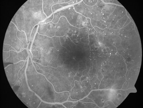 Proliferative Diabetic Retinopathy and Mild Vitreous Hemorrhage
58-year-old woman has diabetic retinopathy in both eyes with neovascularization of the optic nerve, worse in the right eye than the left eye.  Vision OD is 20/25, OS is 20/20
