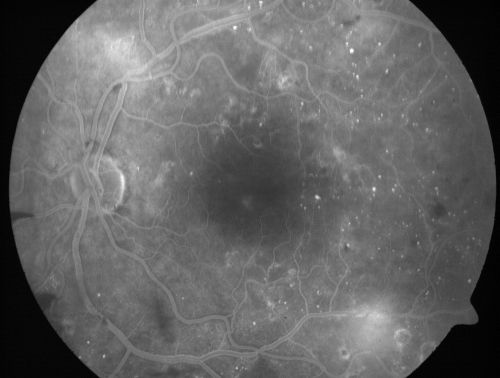 Proliferative Diabetic Retinopathy and Mild Vitreous Hemorrhage
58-year-old woman has diabetic retinopathy in both eyes with neovascularization of the optic nerve, worse in the right eye than the left eye.  Vision OD is 20/25, OS is 20/20
