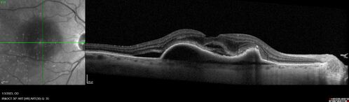 RPE tear following single treatment of vabysmo in the left eye
80 year old patient with HemiCRVO and wet AMD in the left eye.  The right eye has recent vision loss from 20/40 - 20/100.  She has a high PED and wet AMD.  She was given one treatment of half-dose vabysmo and presented next visit with a PED tear and vision of 4/200.
