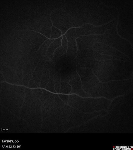 RPE tear following single treatment of vabysmo in the left eye
80 year old patient with HemiCRVO and wet AMD in the left eye.  The right eye has recent vision loss from 20/40 - 20/100.  She has a high PED and wet AMD.  She was given one treatment of half-dose vabysmo and presented next visit with a PED tear and vision of 4/200.

