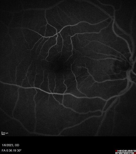 RPE tear following single treatment of vabysmo in the left eye
80 year old patient with HemiCRVO and wet AMD in the left eye.  The right eye has recent vision loss from 20/40 - 20/100.  She has a high PED and wet AMD.  She was given one treatment of half-dose vabysmo and presented next visit with a PED tear and vision of 4/200.
