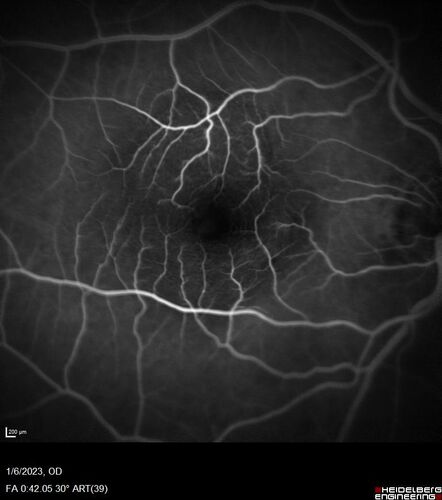 RPE tear following single treatment of vabysmo in the left eye
80 year old patient with HemiCRVO and wet AMD in the left eye.  The right eye has recent vision loss from 20/40 - 20/100.  She has a high PED and wet AMD.  She was given one treatment of half-dose vabysmo and presented next visit with a PED tear and vision of 4/200.
