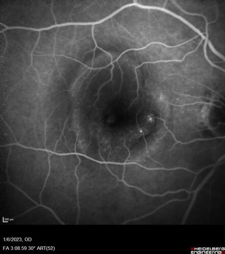 RPE tear following single treatment of vabysmo in the left eye
80 year old patient with HemiCRVO and wet AMD in the left eye.  The right eye has recent vision loss from 20/40 - 20/100.  She has a high PED and wet AMD.  She was given one treatment of half-dose vabysmo and presented next visit with a PED tear and vision of 4/200.
