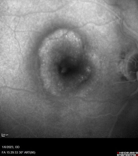 RPE tear following single treatment of vabysmo in the left eye
80 year old patient with HemiCRVO and wet AMD in the left eye.  The right eye has recent vision loss from 20/40 - 20/100.  She has a high PED and wet AMD.  She was given one treatment of half-dose vabysmo and presented next visit with a PED tear and vision of 4/200.
