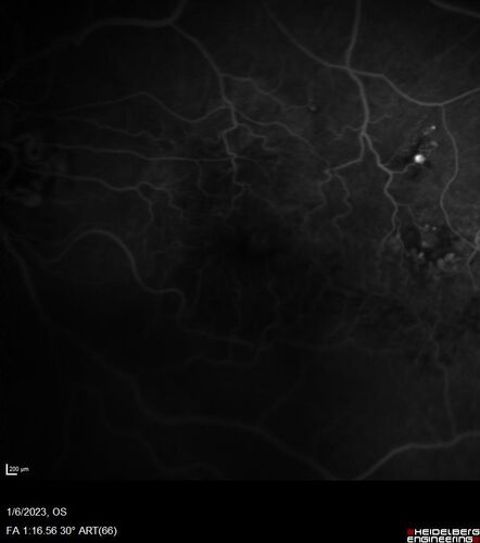 RPE tear following single treatment of vabysmo in the left eye
80 year old patient with HemiCRVO and wet AMD in the left eye.  The right eye has recent vision loss from 20/40 - 20/100.  She has a high PED and wet AMD.  She was given one treatment of half-dose vabysmo and presented next visit with a PED tear and vision of 4/200.
