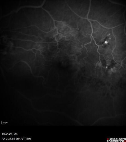 RPE tear following single treatment of vabysmo in the left eye
80 year old patient with HemiCRVO and wet AMD in the left eye.  The right eye has recent vision loss from 20/40 - 20/100.  She has a high PED and wet AMD.  She was given one treatment of half-dose vabysmo and presented next visit with a PED tear and vision of 4/200.
