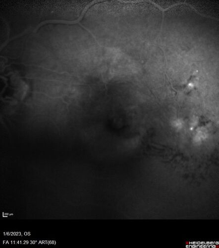 RPE tear following single treatment of vabysmo in the left eye
80 year old patient with HemiCRVO and wet AMD in the left eye.  The right eye has recent vision loss from 20/40 - 20/100.  She has a high PED and wet AMD.  She was given one treatment of half-dose vabysmo and presented next visit with a PED tear and vision of 4/200.
