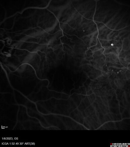 RPE tear following single treatment of vabysmo in the left eye
80 year old patient with HemiCRVO and wet AMD in the left eye.  The right eye has recent vision loss from 20/40 - 20/100.  She has a high PED and wet AMD.  She was given one treatment of half-dose vabysmo and presented next visit with a PED tear and vision of 4/200.
