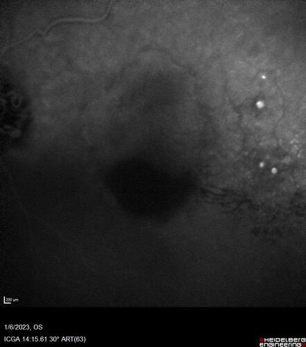 RPE tear following single treatment of vabysmo in the left eye
80 year old patient with HemiCRVO and wet AMD in the left eye.  The right eye has recent vision loss from 20/40 - 20/100.  She has a high PED and wet AMD.  She was given one treatment of half-dose vabysmo and presented next visit with a PED tear and vision of 4/200.
