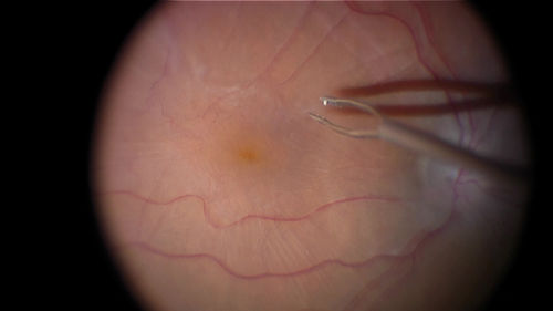Vitrectomy with membrane peel
Intraoperative images showing the peeling of an epiretinal membrane - macular pucker - with a 25 gauge forcepts.
