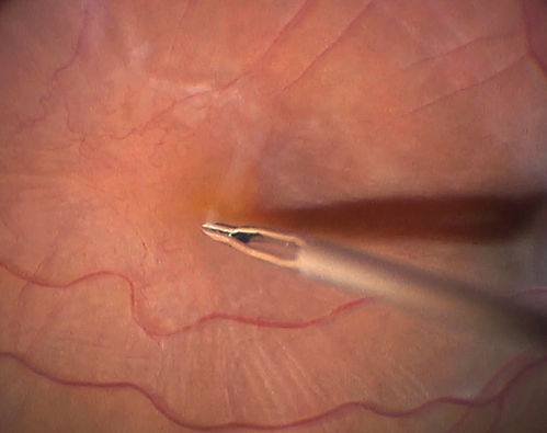 Vitrectomy with membrane peel
Intraoperative images showing the peeling of an epiretinal membrane - macular pucker - with a 25 gauge forcepts.
