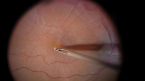 Vitrectomy with membrane peel
Intraoperative images showing the peeling of an epiretinal membrane - macular pucker - with a 25 gauge forcepts.
