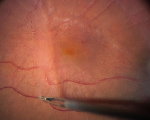 Vitrectomy with membrane peel
Intraoperative images showing the peeling of an epiretinal membrane - macular pucker - with a 25 gauge forcepts.
