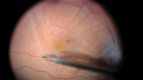 Vitrectomy with membrane peel
Intraoperative images showing the peeling of an epiretinal membrane - macular pucker - with a 25 gauge forcepts.
